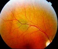 choroidal nevus.jpg